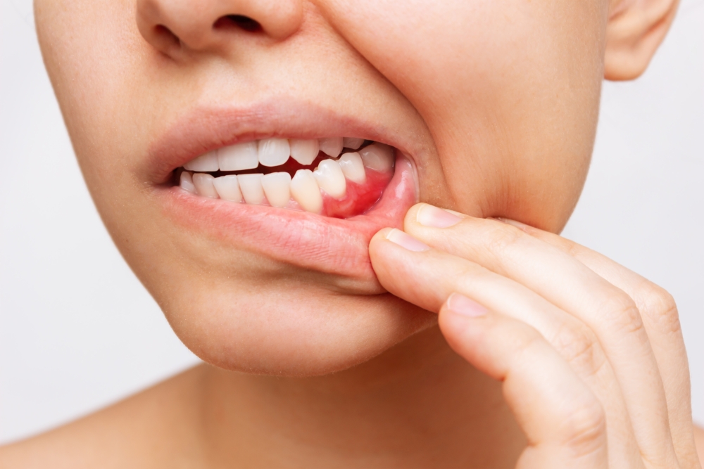LECZENIE CHORÓB DZIĄSEŁ I PRZYZĘBIA ( PERIODONTOLOGIA)