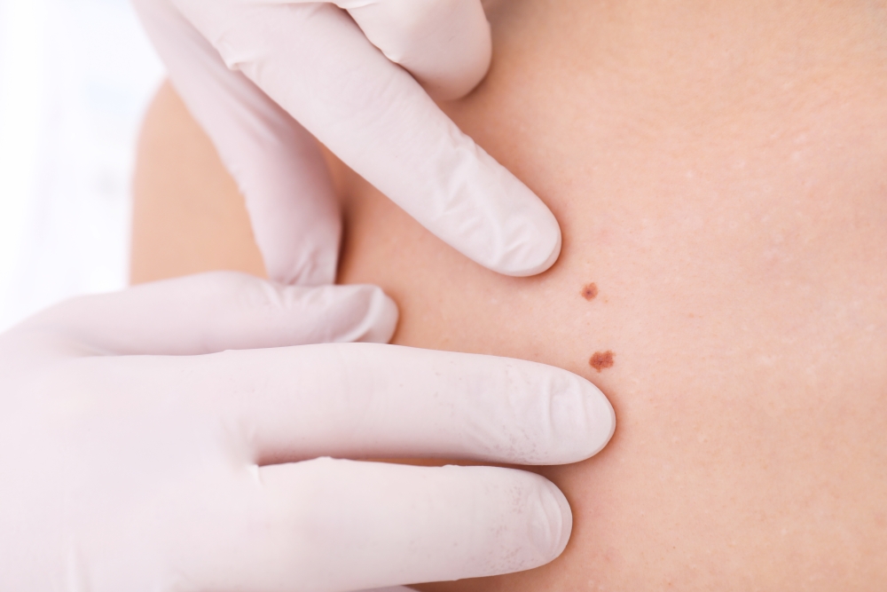 DIAGNOSTYKA I LECZENIE NOWOTWORÓW SKÓRY